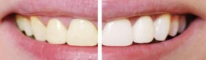 Teeth Whitening Myths and Facts