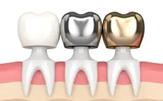 Porcelain fused metal dental crown