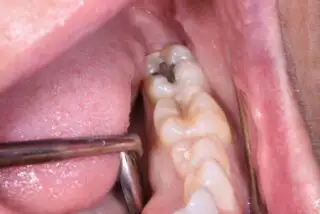 Tooth Decay