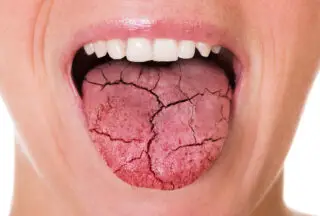 Cracked sore tongue