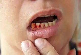 gum disease 