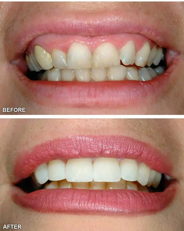 Gum Reconstruction and Periodontal Maintainance in Houston, TX