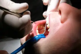 periodontal cleaning