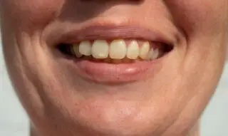 whites stains on teeth