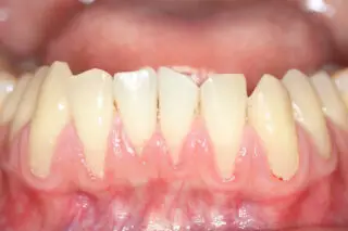receeding gums