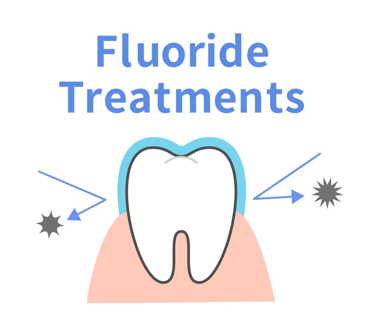 Fluoride Treatments