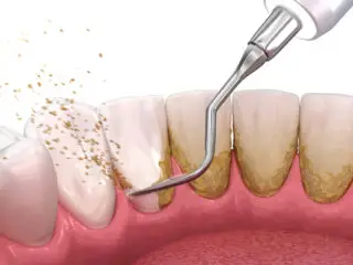 periodontal gum cleaning