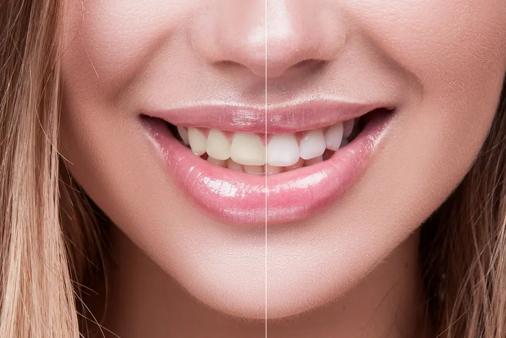 Benefits of Cosmetic Dentistry for long time