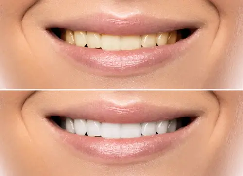 Teeth Whitening | Adentalcare