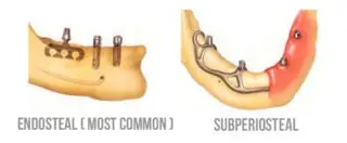 orthodontist implants in houston