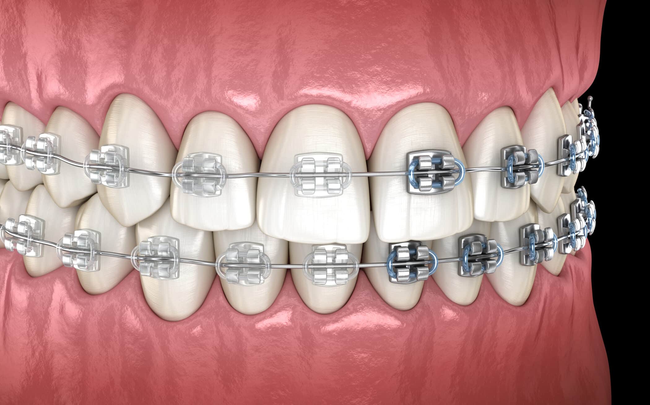 Application of metal braces