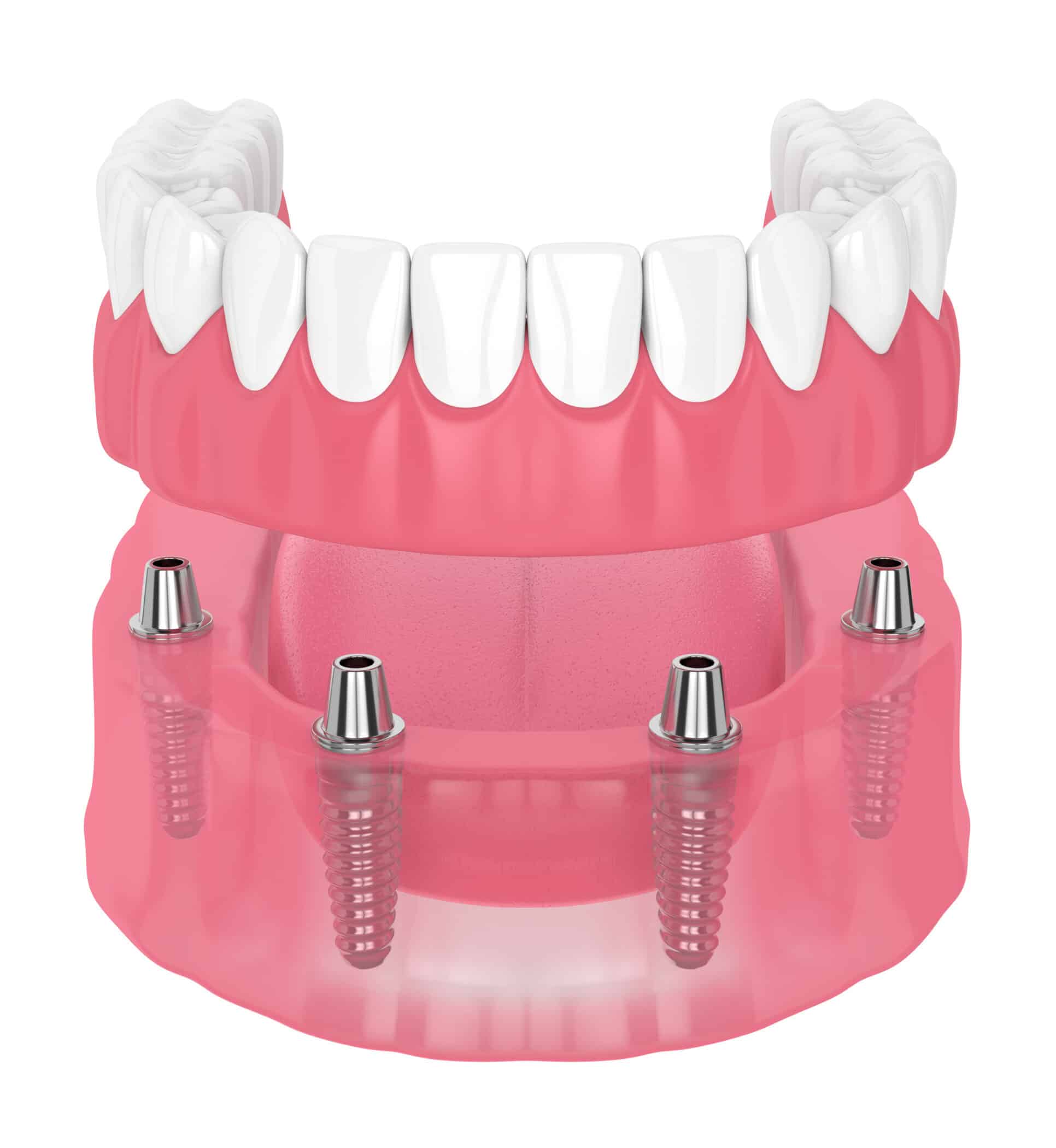 3d render of removable full implant denture