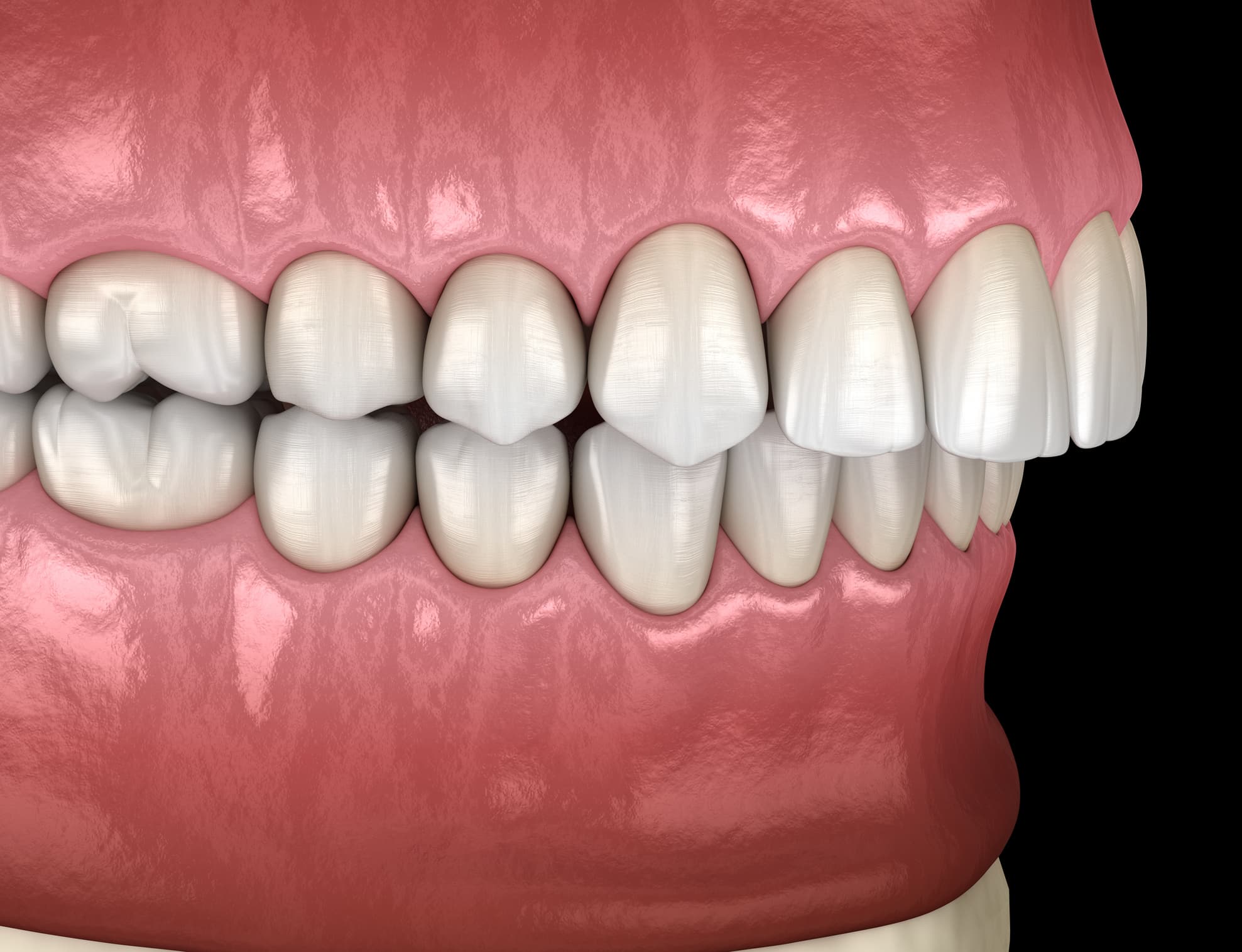 Overbite dental occlusion