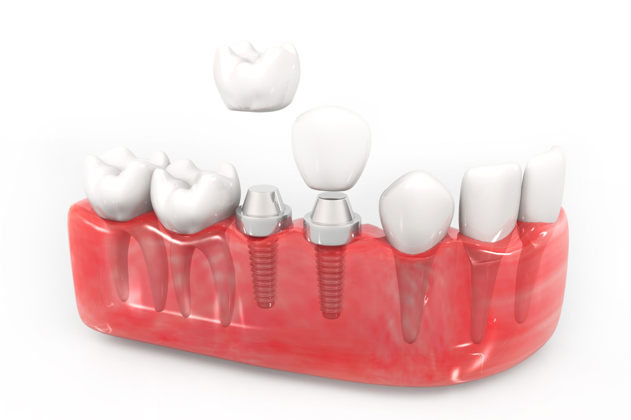 Dental implant installation
