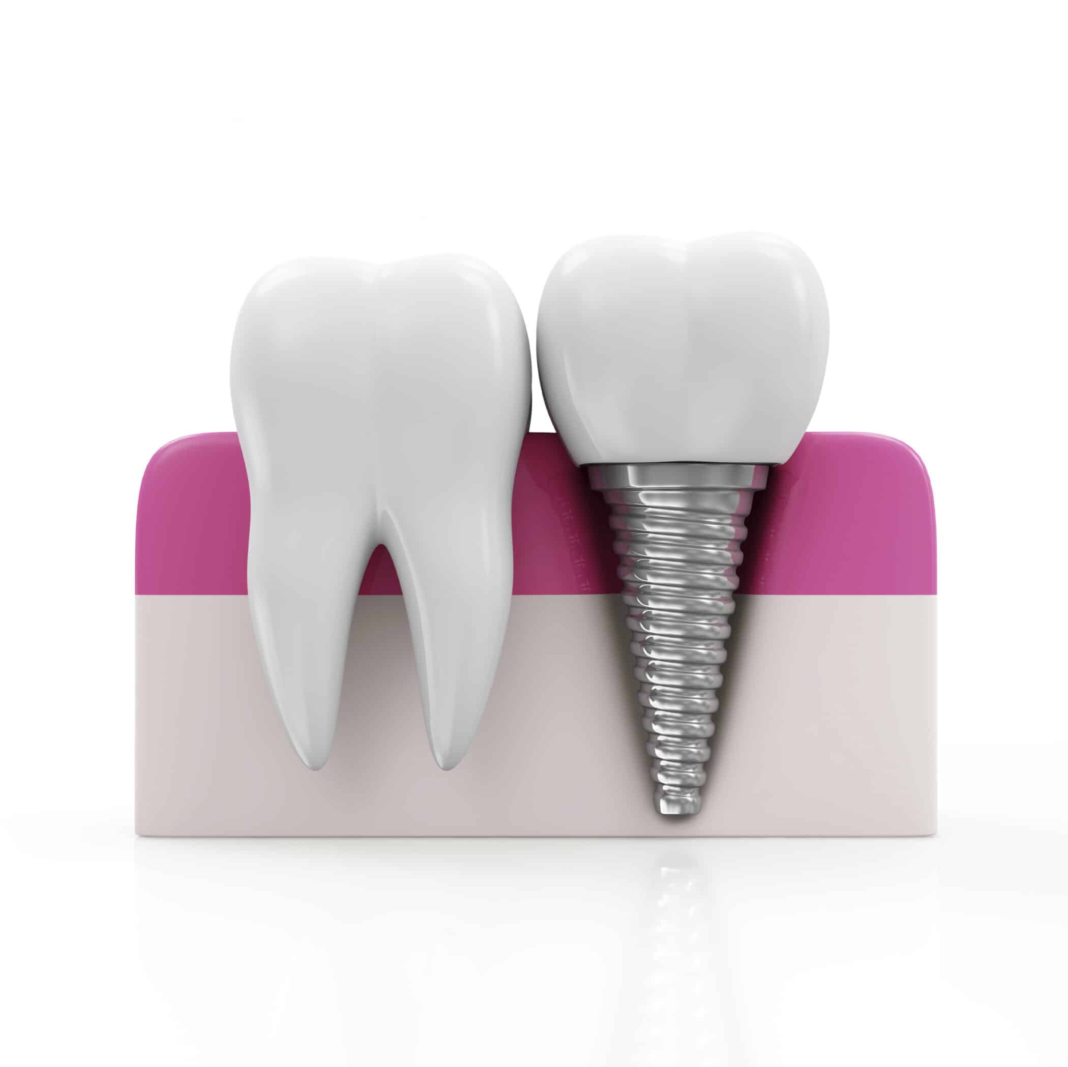 Implant-tooth and healthy-tooth