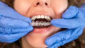 Types of Teeth Gaps