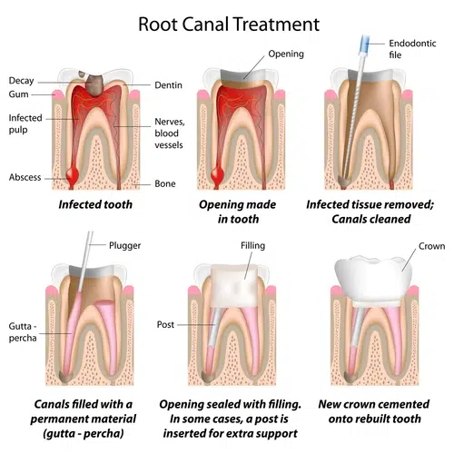 What is Root Canal Procedure Infographic
