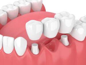 Comparing the Cost for a dental crown