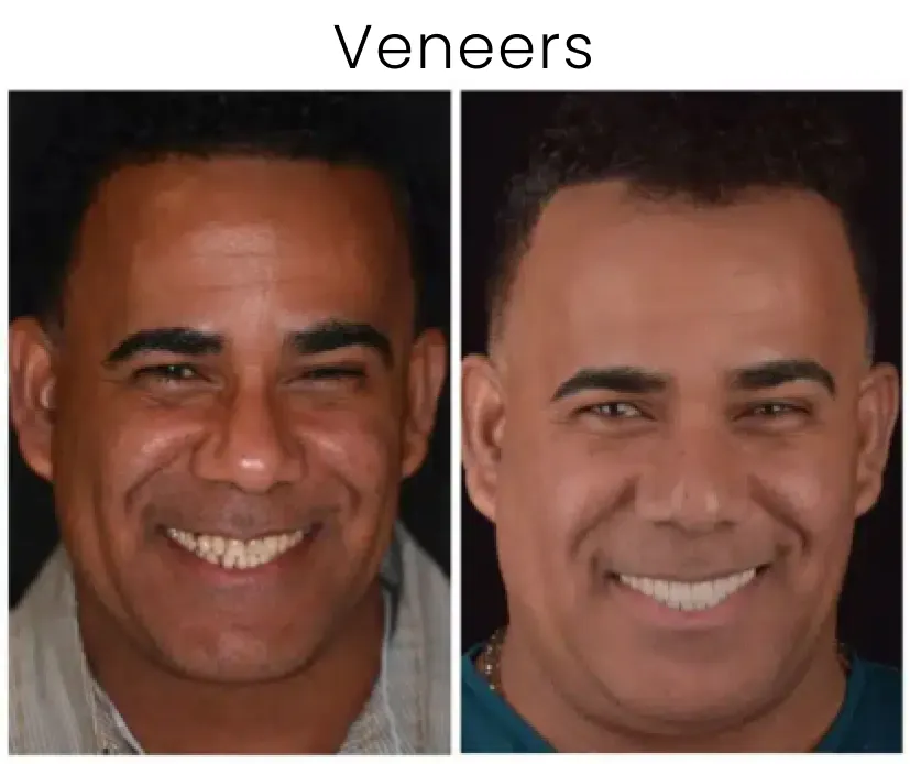 Dental Veneers Before and After 5
