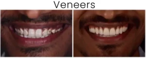 Dental Veneers Before and After 6