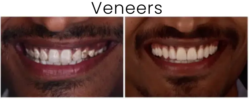 Dental Veneers Before and After 6