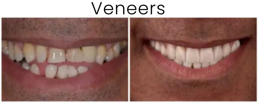 Dental Veneers Before and After 4