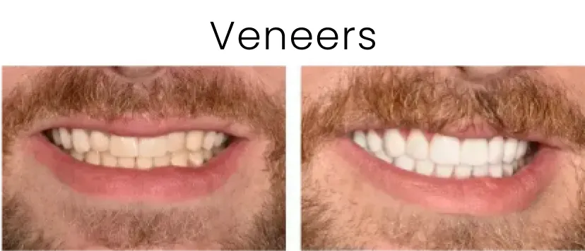 Dental Veneers Before and After 1
