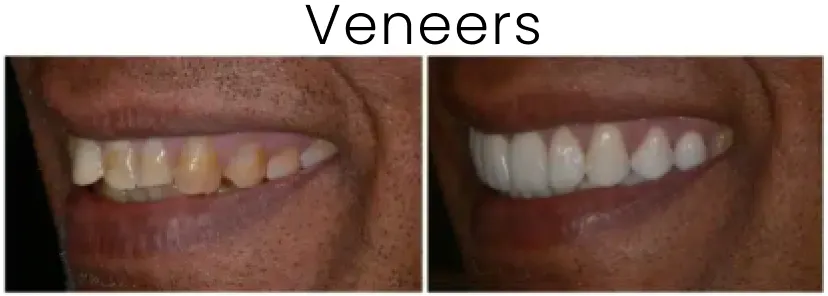Dental Veneers Before and After 2