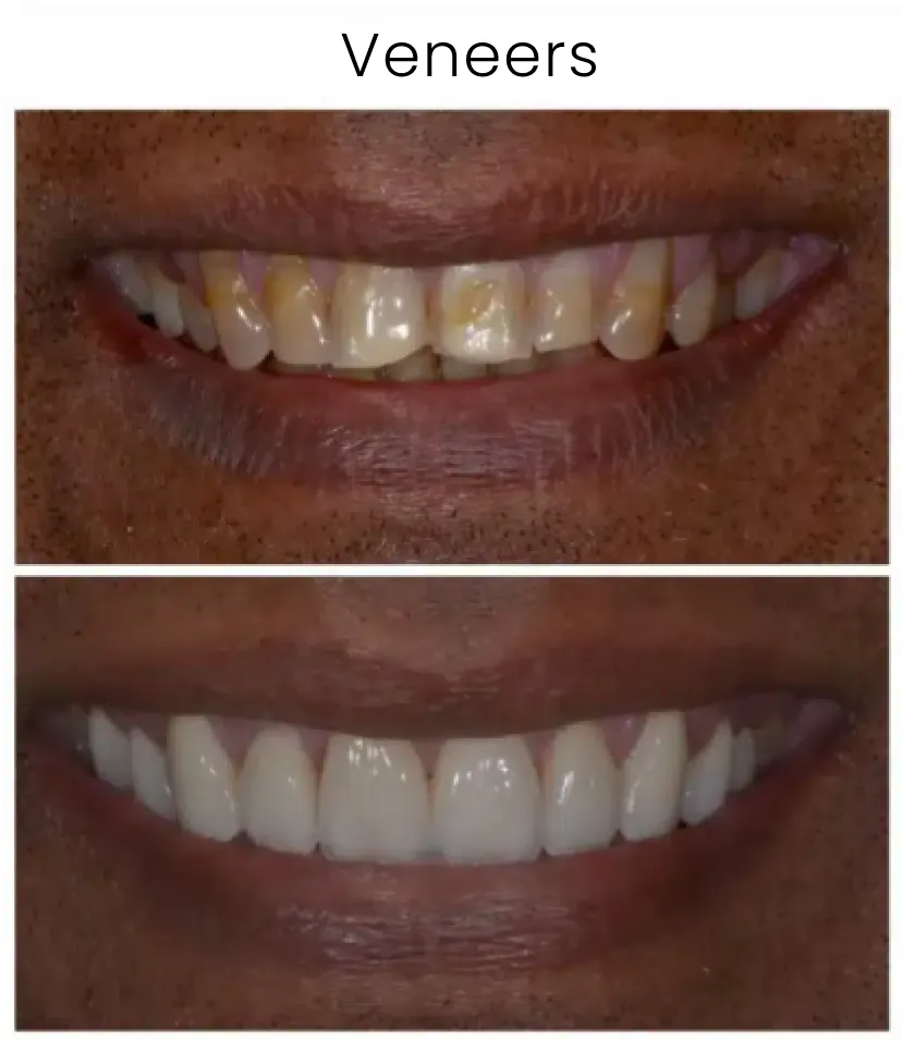 Dental Veneers Before and After 3