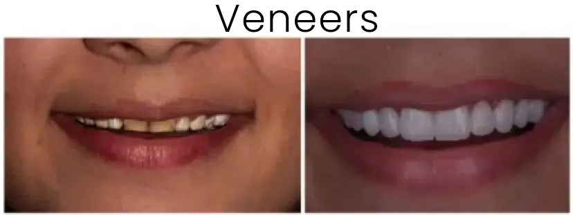 Dental Veneers Before and After 5
