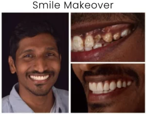 Smile Makeover Before and After