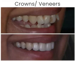 Dental Veneers Before and After 7