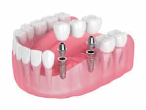 Implant supported Dental Bridges