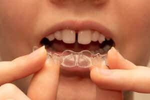 A woman putting on Invisalign Clear Aligners to close down on teeth gaps