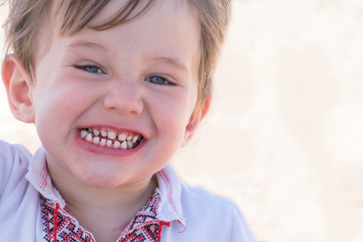 Congenitally Missing Teeth in a Child