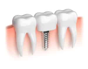 Diagram showing a single tooth implant