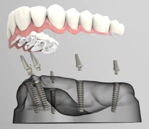 Image showing full mouth dental implants