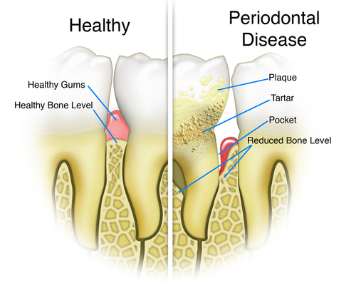 Development of Gum Disease