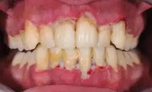 image showing periodontal disease